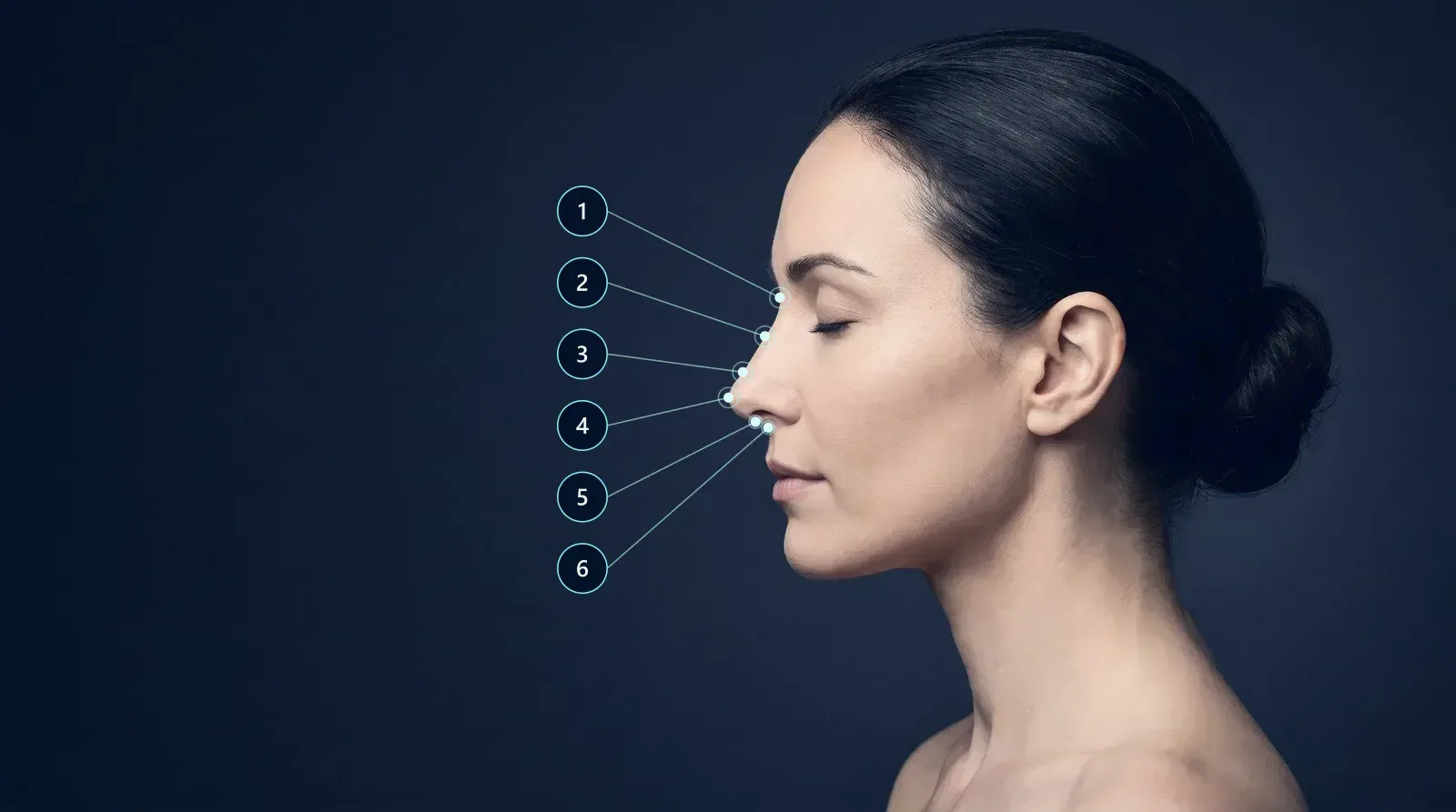 Rinomodelación permanente — Dorso nasal