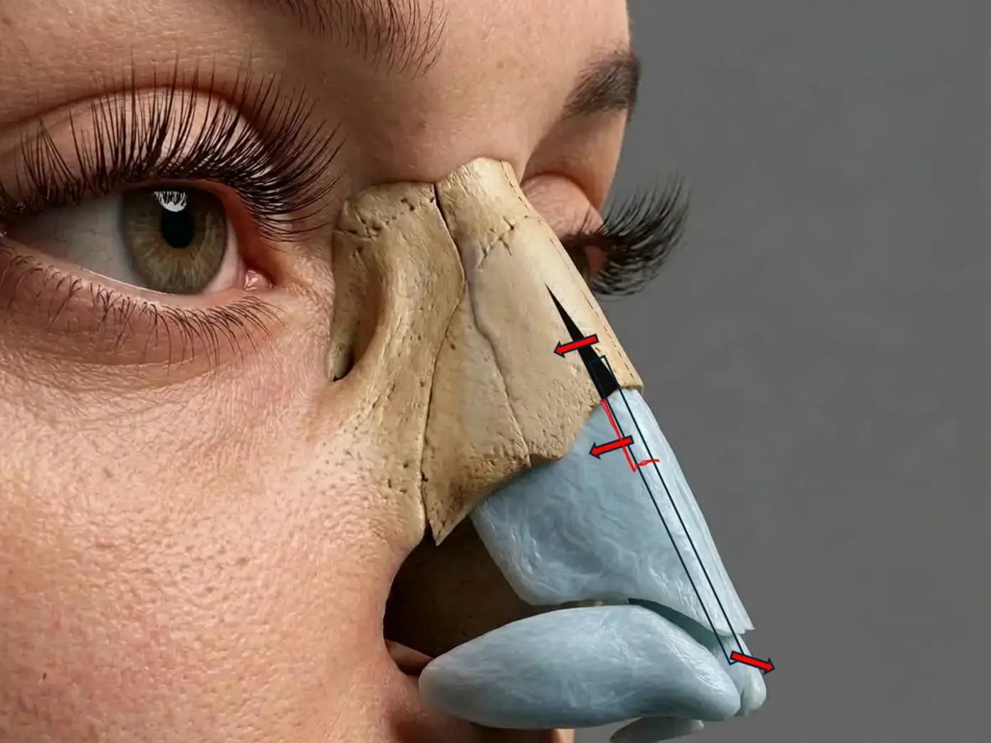 3D vectorial model of NOVA Spare Roof preservation rhinoplasty: paramedian osteotomy, keystone release and descent vectors